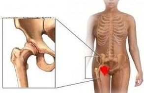 The reasons for the development of arthrosis of the hip joint
