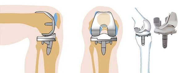 Endoprosthetics operation of the knee joint for arthrosis