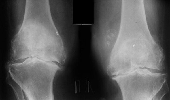 X -ray as a way of diagnosing arthrosis of the knee joint