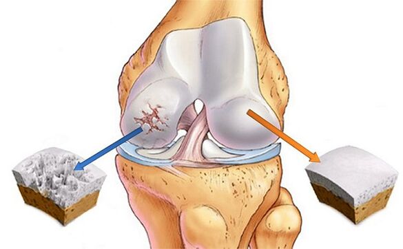 norm and deviation for arthrosis of the knee joint