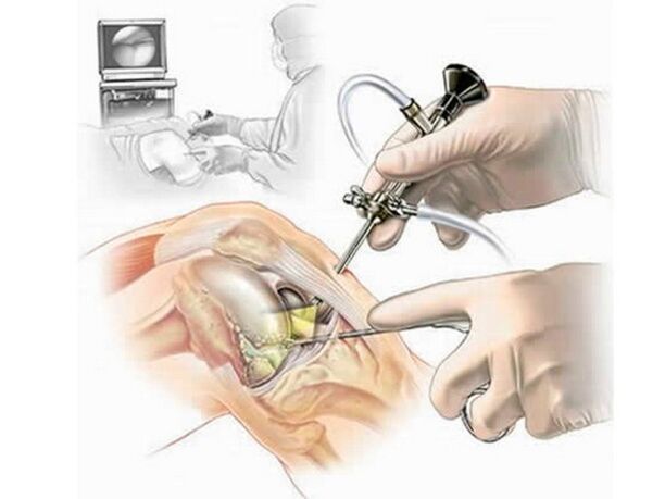 Arthroscopy of the knee joint