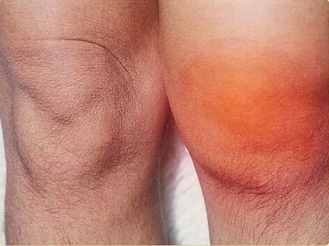 Inflammation of the knee joint affected by arthritis