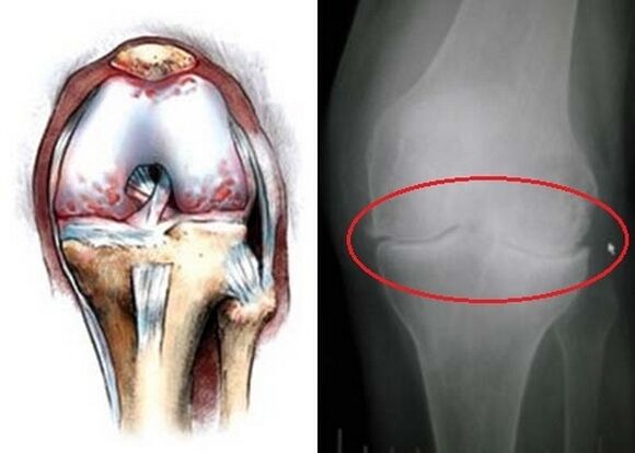 The deformation of the knee joint for arthrosis